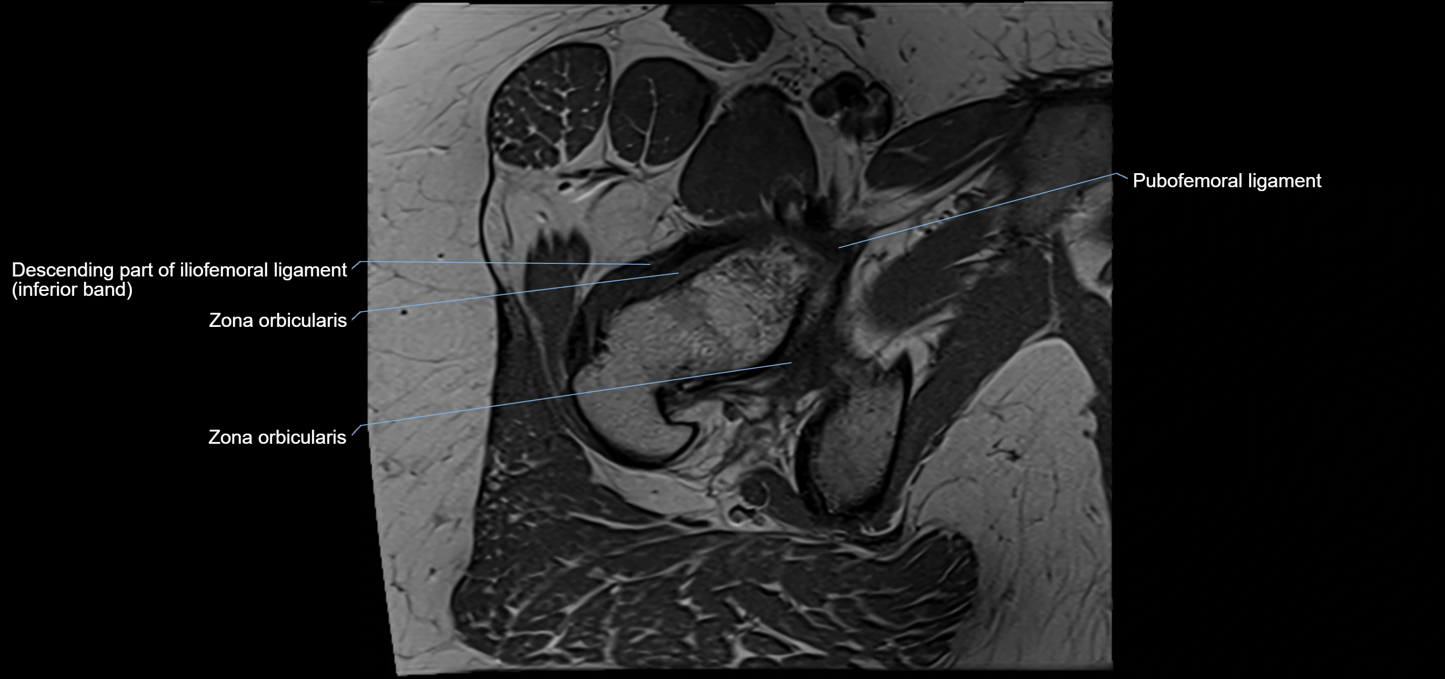 Hip ligament anatomy axial 3T MRI image -img-13001-00021.webp